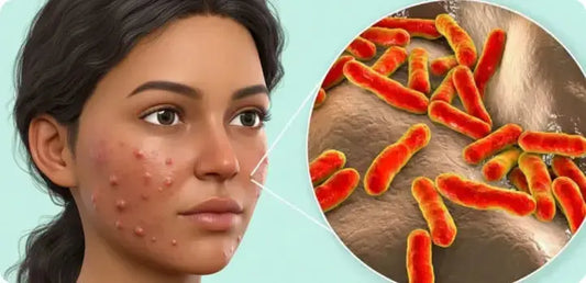 What Causes Acne? Beyond Skincare and Serums - BreakoutLabs
