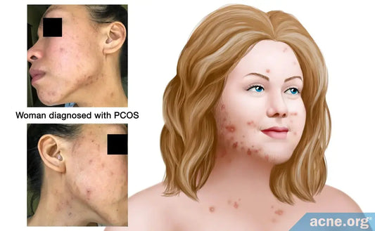 Hormonal Acne and PCOS: Understanding the Link - BreakoutLabs