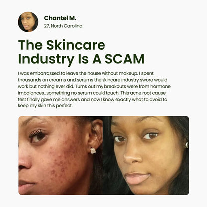 BreakoutLabs Acne Root Cause Test BreakoutLabs