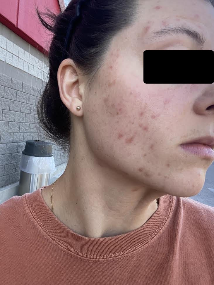 Lindsay P., with red breakouts across her cheek and jaw before making changes
