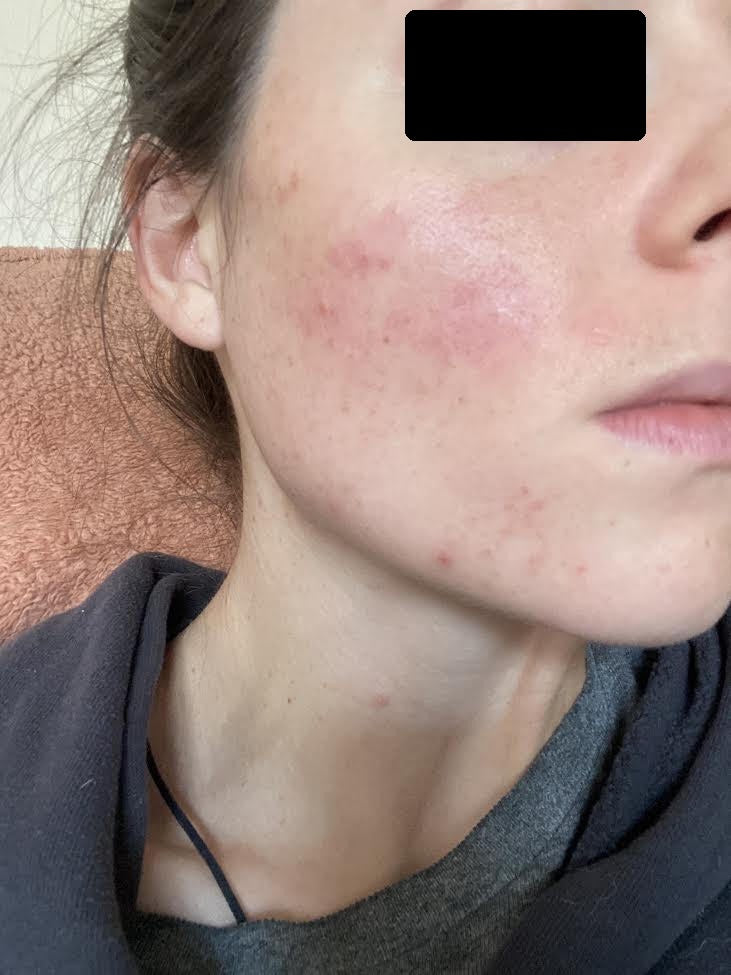 Lindsay P., with red inflamed skin on her cheek before making changes