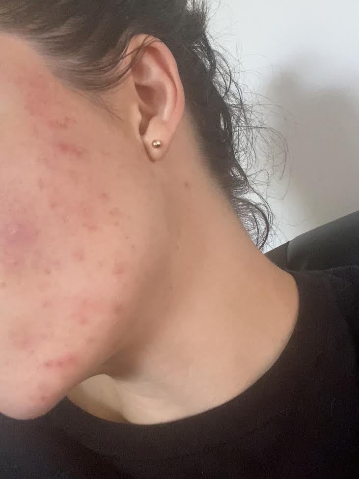 Side view of Lindsay P.'s cheek and jawline with red breakouts before making changes